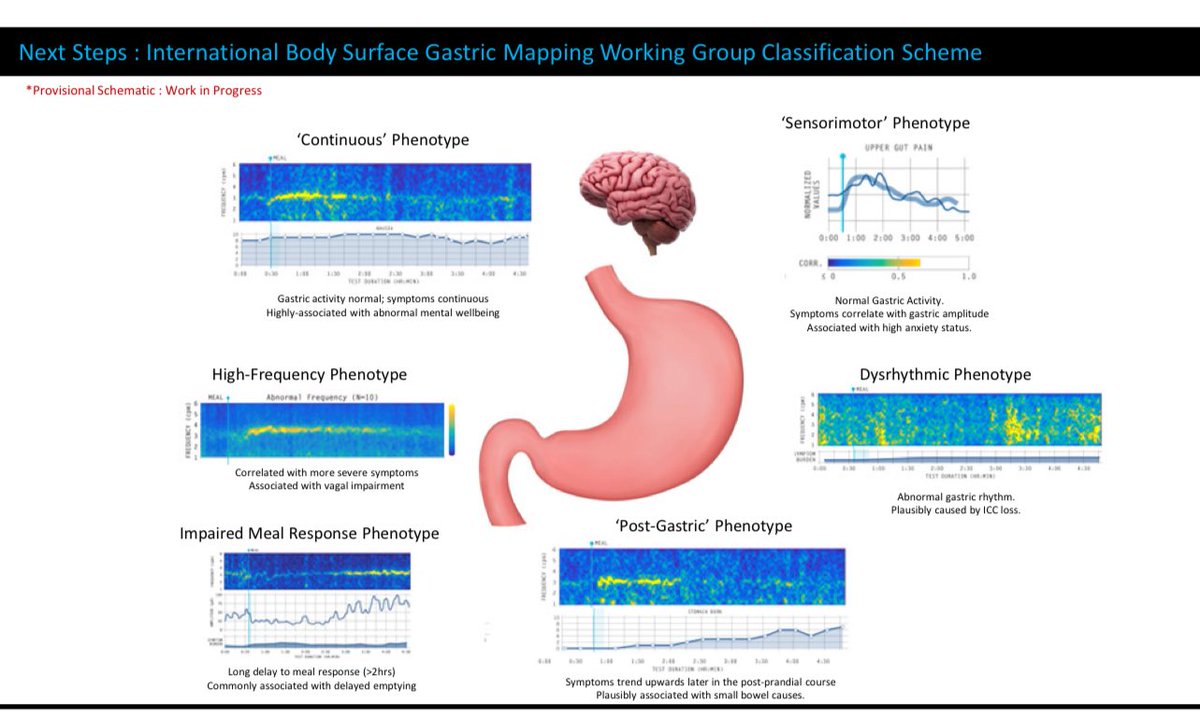 Xiao Jing (Iris) Wang, M.D. (@iriswangmd) on Twitter photo Amazing work in body surface gastric mapping presented by Dr <a href="/ogrady_greg/">Greg O'Grady</a> at #ANMS2025
😅DGBIs = type 3 problem: unclear cause, unclear sole
🚀Mechanisms and biomarkers = future
⚡️Body surface gastric mapping ➡️ different phenotypes
⏭️ Next: Phenotypes predicts Tx response? Amazing work in body surface gastric mapping presented by Dr <a href="/ogrady_greg/">Greg O'Grady</a> at #ANMS2025
😅DGBIs = type 3 problem: unclear cause, unclear sole
🚀Mechanisms and biomarkers = future
⚡️Body surface gastric mapping ➡️ different phenotypes
⏭️ Next: Phenotypes predicts Tx response?