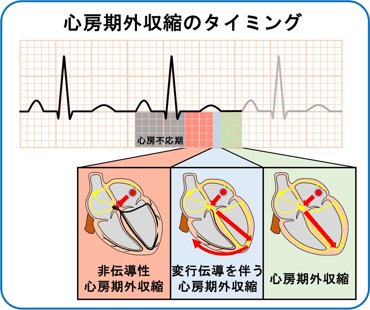 心房期外収縮はタイミングが早いと非伝導性や変行伝導を伴います。(図のタイミングはあくまでイメージですのでmsec等は変動します)