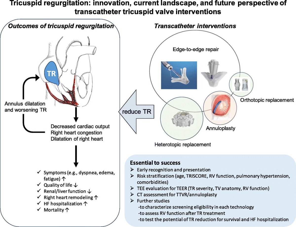 Journal of Cardiology (@j_cardiol) on Twitter photo #JCardiol 86(2): 119-26, 2025
✅Review
Tricuspid regurgitation: Innovation, current landscape, and future perspective of transcatheter tricuspid valve interventions
Sugiura A et al
<a href="/AtsushiSssugi/">Atsushi Sugiura</a>
doi.org/10.1016/j.jjcc…
by A.E. K #JCardiol 86(2): 119-26, 2025
✅Review
Tricuspid regurgitation: Innovation, current landscape, and future perspective of transcatheter tricuspid valve interventions
Sugiura A et al
<a href="/AtsushiSssugi/">Atsushi Sugiura</a>
doi.org/10.1016/j.jjcc…
by A.E. K