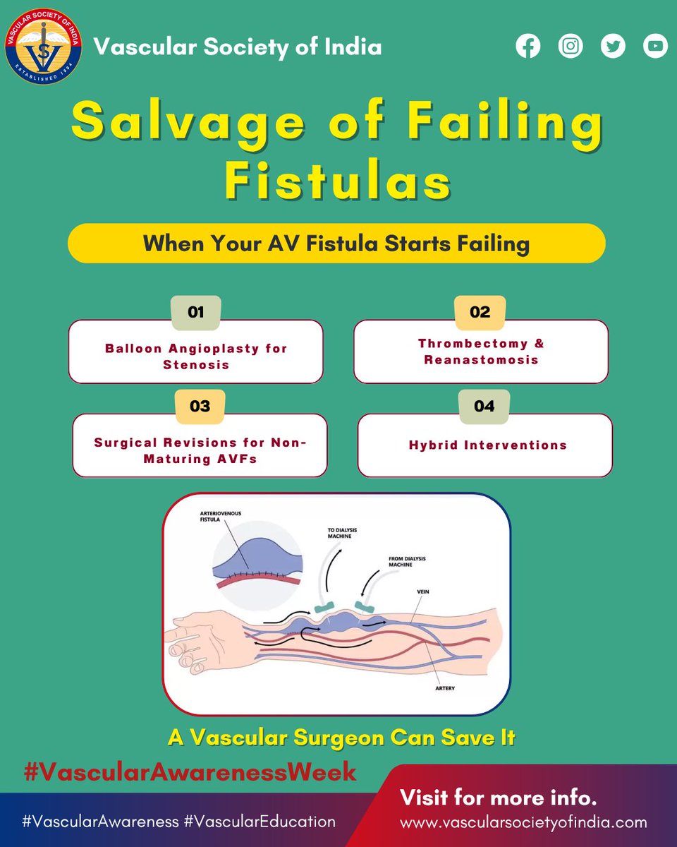Vascular_India's tweet photo. 🩺 From AV fistula creation to complication repair & central vein angioplasty — vascular surgeons provide complete, precise care for dialysis access. Your AV fistula deserves expert hands.
#VascularAwarenessWeek #VascularAwareness #VascularEducation https://t.co/TPx2CicaAq