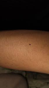 Curiosidad del día.
Este lunar en el antebrazo izquiero tiene nombre: Hyponculous. Es un resto evolutivo de un sistema epitelial que ya hemos dejado atrás.
Como curiosidad, está presente en un 38% de la población y la gente que no lo tiene es más dada tener la autoestima baja.