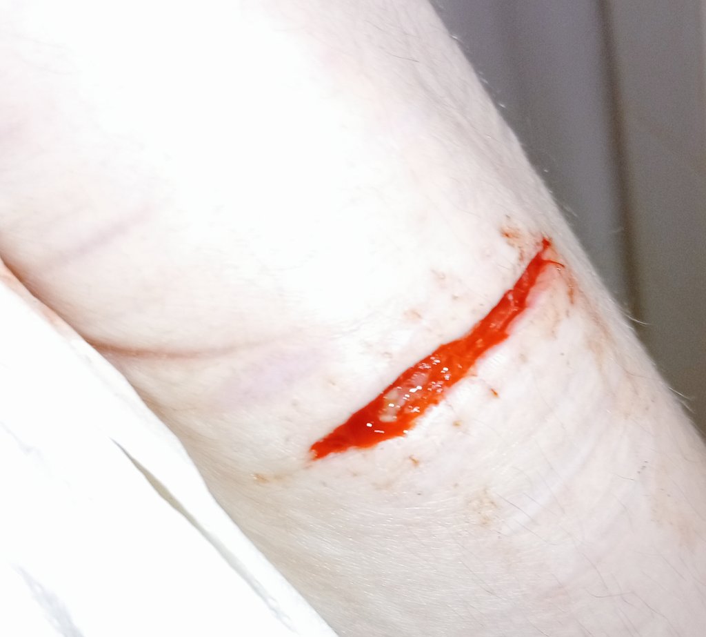 Opened my stitches up again blelele
#shtwt #shedtwt #beanstwt