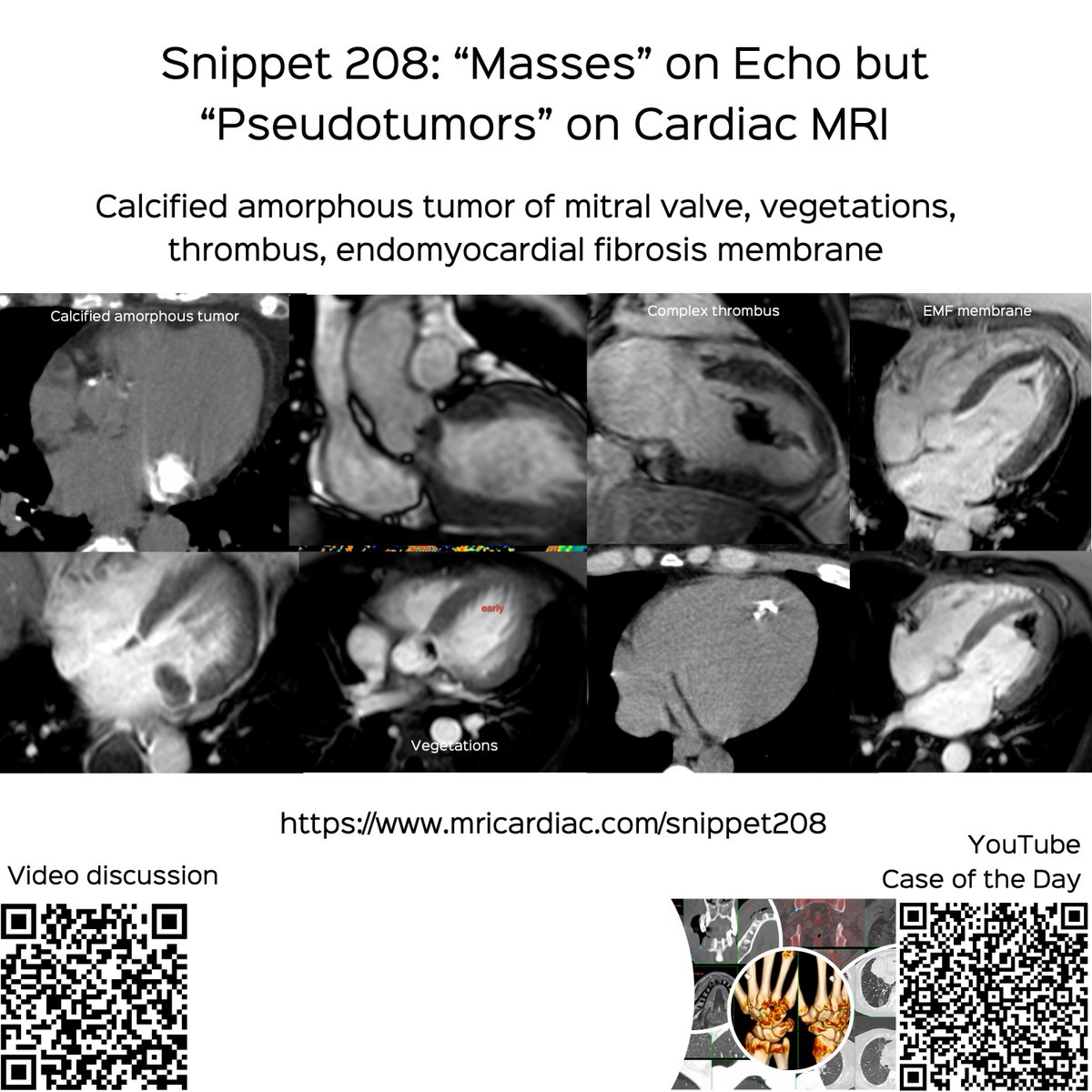 bhavinj's tweet image. Snippet 208: “Snippet 208: “Masses” on Echo but “Pseudotumors” on Cardiac MRI

Calcified amorphous tumor of mitral valve, vegetations, thrombus, endomyocardial fibrosis membrane

Video and discussion
mricardiac.com/snippet208/

#cmrsimplified #cmr #cardiacmri #whyCMR #mitralvalve