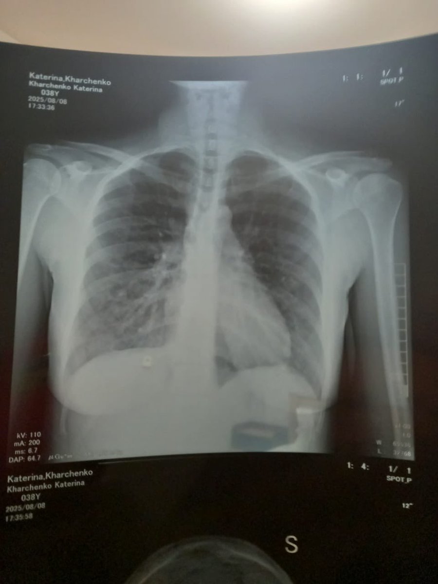 usgzrm's tweet photo. high-altitude pulmonary edema - HAPE, a complication of which is pneumonia. https://t.co/BQVFcPB7fs