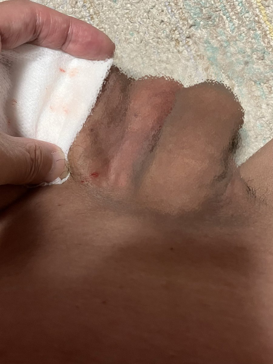 閲覧注意⚠️⚠️⚠️
パイパン失敗、血が出た😭