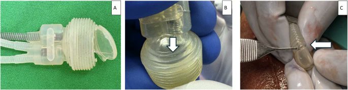 IJIR: Your Sexual Medicine Journal (@yoursexmedjour) on Twitter photo Mechanical failure of inflatable #penileprosthesis: a 2025 snapshot and historical context 👉 rdcu.be/ez1Jn
<a href="/profskwilson/">SK Wilson, MD</a> <a href="/SexHealthMD/">Tobias S. Köhler, MD, MPH</a> <a href="/MayoUrology/">Mayo Clinic Urology</a> <a href="/DrPaulPerito/">Perito Urology</a> <a href="/ahmettevfikal/">Op. Dr. Ahmet Tevfik Albayrak</a> Mechanical failure of inflatable #penileprosthesis: a 2025 snapshot and historical context 👉 rdcu.be/ez1Jn
<a href="/profskwilson/">SK Wilson, MD</a> <a href="/SexHealthMD/">Tobias S. Köhler, MD, MPH</a> <a href="/MayoUrology/">Mayo Clinic Urology</a> <a href="/DrPaulPerito/">Perito Urology</a> <a href="/ahmettevfikal/">Op. Dr. Ahmet Tevfik Albayrak</a>