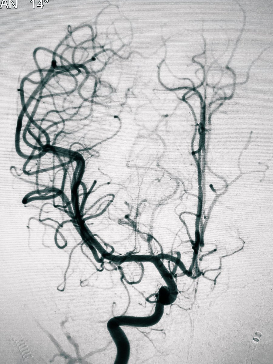 Dual Route / Trans-Acom.A embolization of a ruptured microAVM from the recurrent artery of Heubner in a 4-year-old.