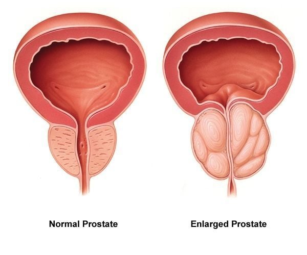 Men,

Here is something on MEN'S HEALTH that you should know:

The most essential nutrient in the health of your prostate is ZINC.

Best sources of ZINC:

• Red Meat

• Oysters

• Sea fish

• Pumpkins

Zinc blocks the action of an enzyme called alpha-reductase.