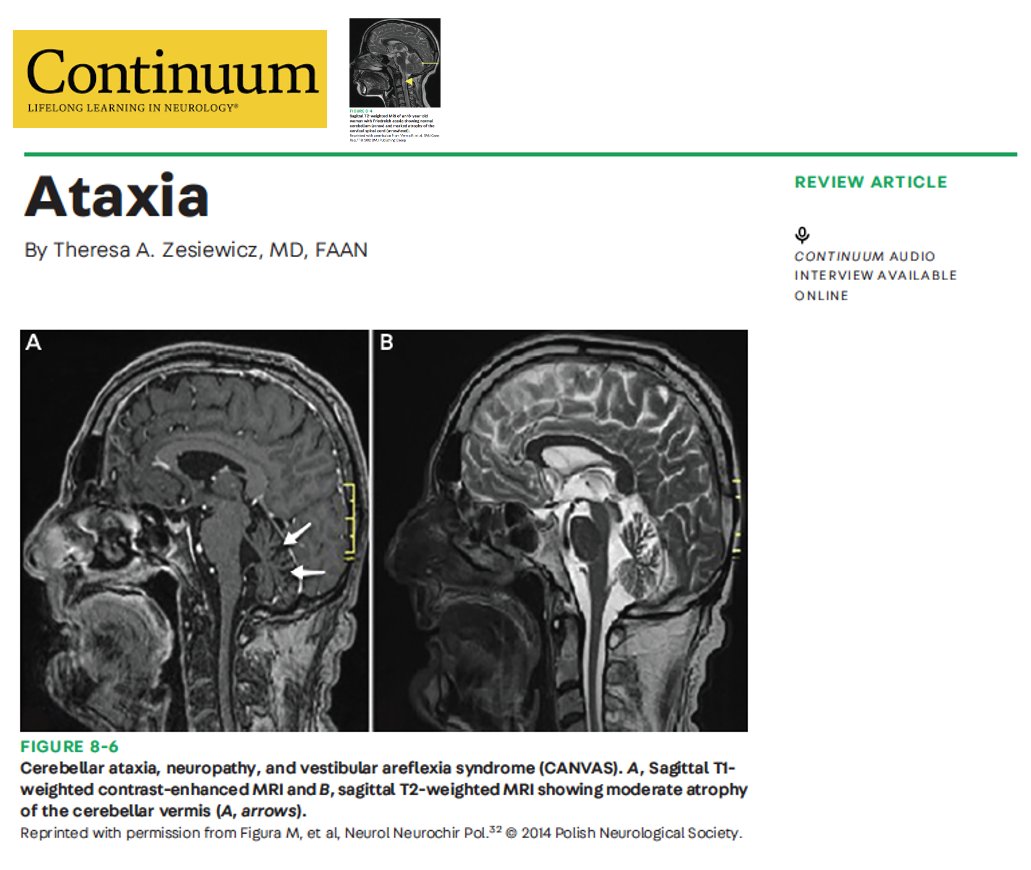 Do you know the 2025 updates for the diagnosis and treatment of ataxia? Can you identify the MRI hallmarks of ataxia? Do you know the new FDA approved drug for treatment? Do you know when and what to order for genetic testing? If you don't know about CANVAS and SCA 27b, you
