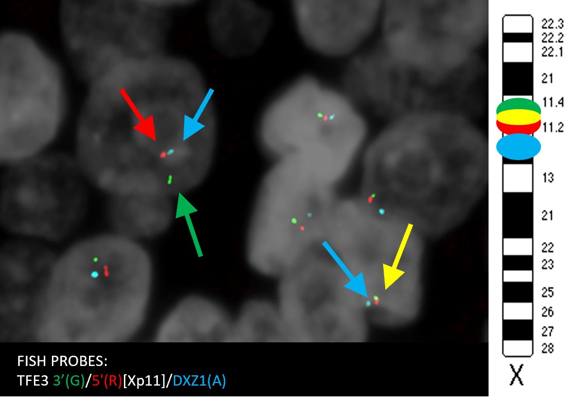 Using FISH to identify paracentric inversions involving TFE3…

sciencedirect.com/science/articl…