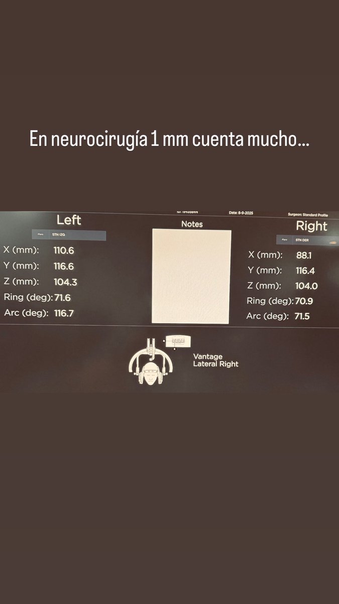 DROSCARZORRO's tweet image. En muchos de los campos de la neurocirugía 1 mm es muy importante para mejores desenlaces, especialmente en estereotaxia, estimulación cerebral profunda.