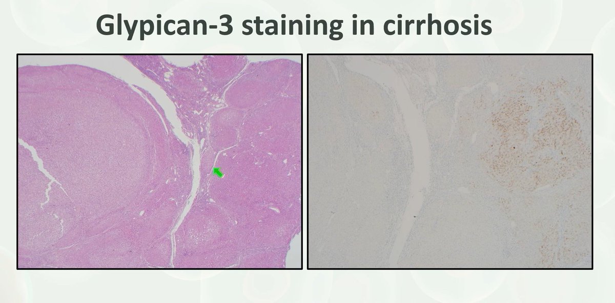 Glypican-3 pitfalls
1. Stains lipochrome/ lipofuscin pigment
 This is non-specific staining and should not be considered positive (as a finding to support HCC)

2. Stains cirrhosis (non-specific staining)

Dr. Chandan #USCAP25 #pathology #PathX