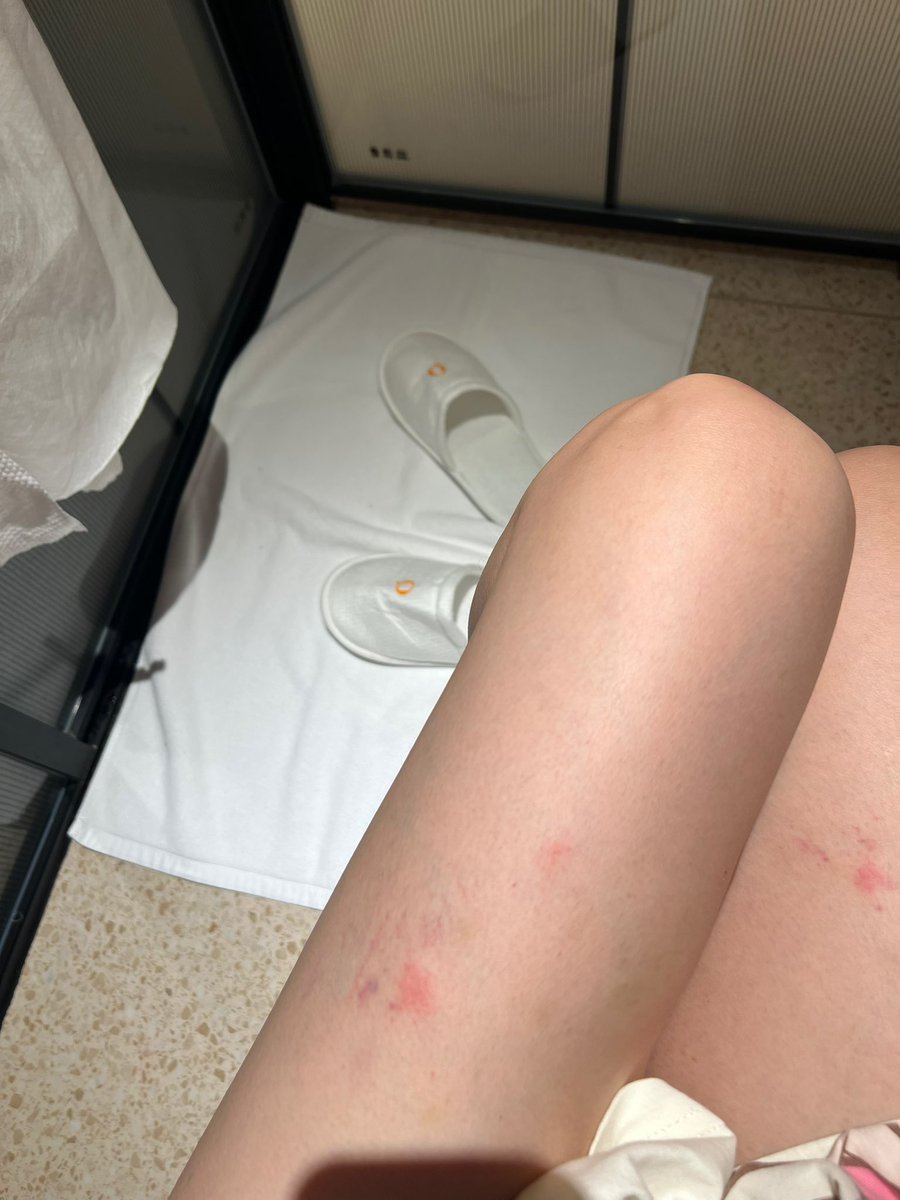 现在的蚊子都好毒☠️