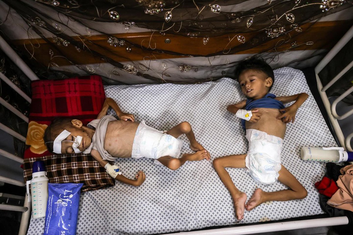 Three-year-old Mohammed Mehreh and his four-year-old brother, Oday Mehreh, remain in critical condition at the Patient Friends Association Hospital as they receive treatment for severe malnutrition.