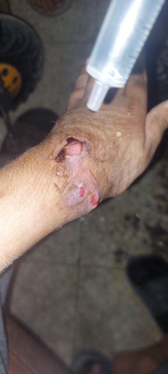 Hamza_1gg0's tweet photo. This is my son Adamโs handโฆ destroyed by hunger and lack of treatment. Please, I beg you, quote this so our story is seen.
#Gaza #HelpAdam
@ireallyhateyou https://t.co/EAmWYLoM2s