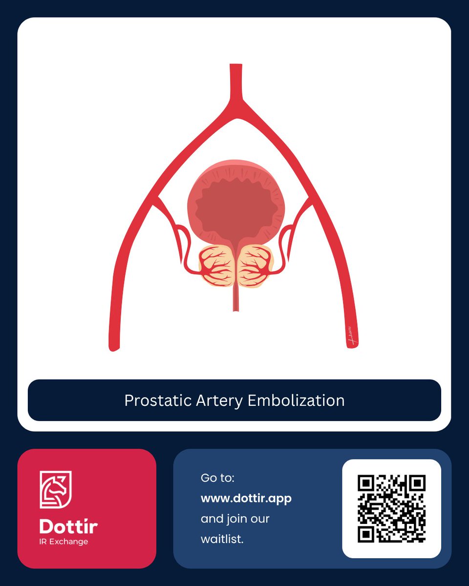 Prostatic artery embolisation (PAE) is a minimally invasive treatment for BPH. Using ultrasound &amp; fluoroscopy, IRs block blood flow to shrink the prostate, easing pressure on the bladder &amp; urethra. Preserves sexual function, fewer complications, faster recovery. #PAE #BPH #IR