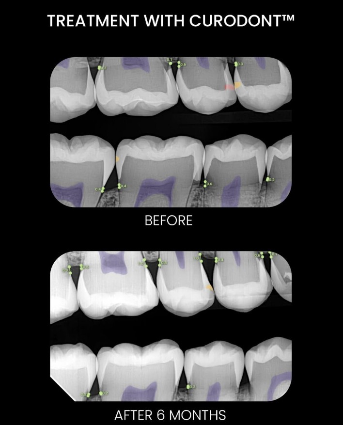 DentalArtsDrX's tweet image. We're excited to now offer VVARDIS, a new product for advanced teeth remineralization! This non-invasive treatment strengthens enamel, reduces sensitivity, and protects against future damage. Ask us about it at your next appointment!

 #VVARDIS #dentalhealth #remineralization