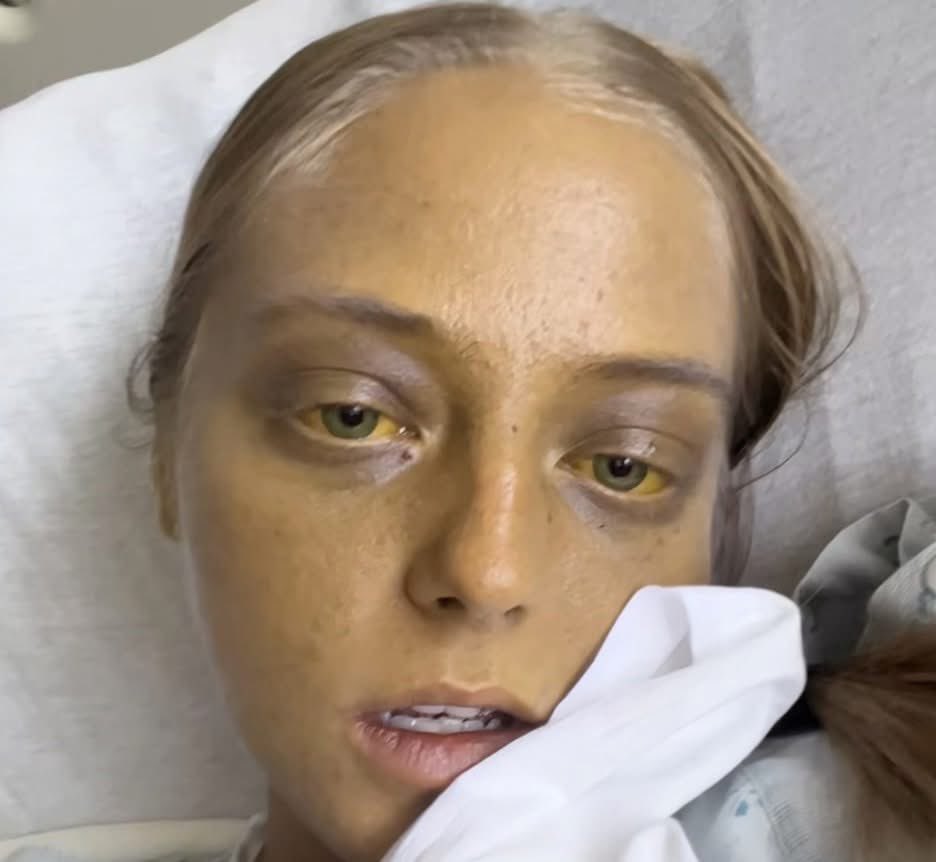 A young woman with fatigue, jaundice, and positive anti-smooth muscle antibodies likely has ?
A. Wilson's Disease
B. Autoimmune Hepatitis
C. Primary Biliary Cholangitis
D. Acute Viral Hepatitis

#MEDHM #MedX <a href="/IhabFathiSulima/">Dr Ihab Suliman</a>