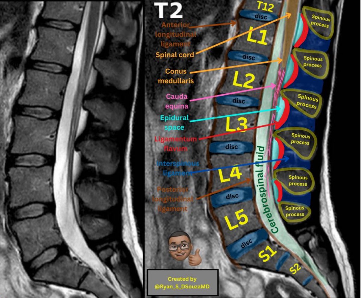 Lumbar MRI sagittal cut T2 sequence! Unlabelled side on the left for reference.📌
