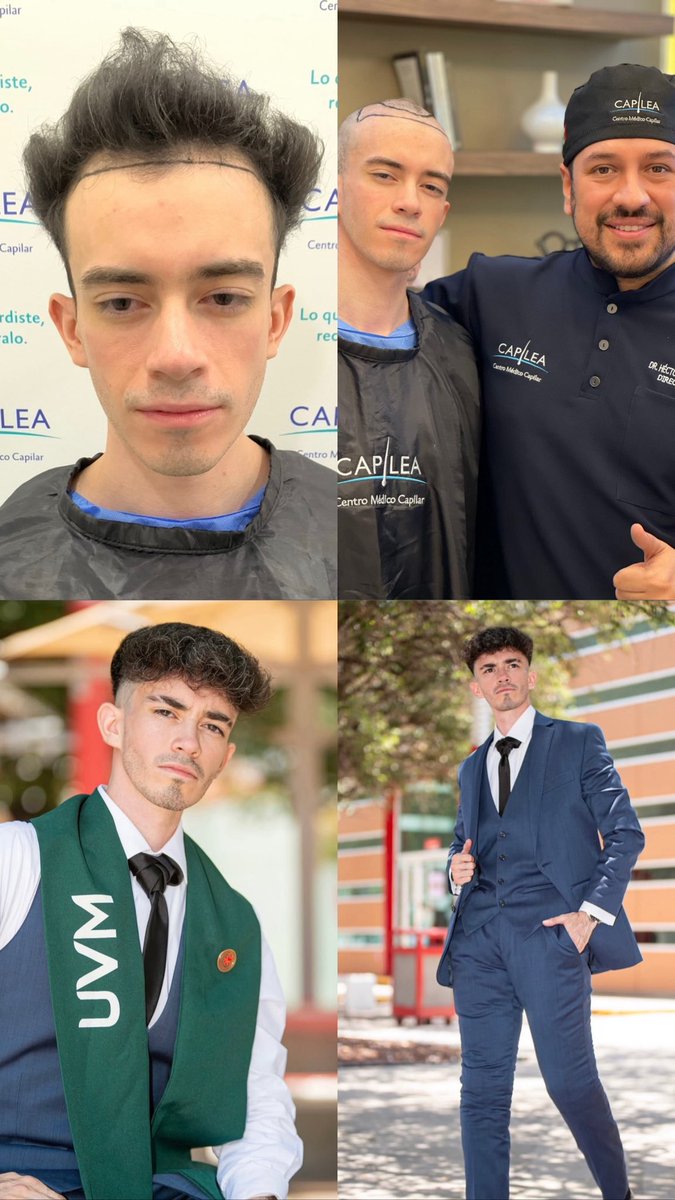Aviso COFEPRIS 2319012002A00017
#drhectortreviño #capilea #capileamonterrey #hairtrasplant #injertocapilar #microinjertocapilar  #fuetechnique #trasplantecapilar   #capileatijuana #capileacdmx #drhectortrevino #capileamexico #hairtrasplantsurgeon