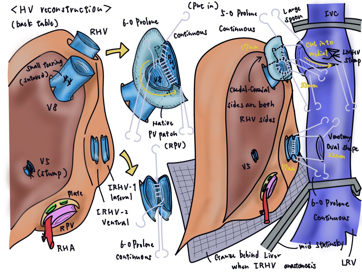 複雑な肝静脈再建こそが肝移植の肝なんだと最近思ふ