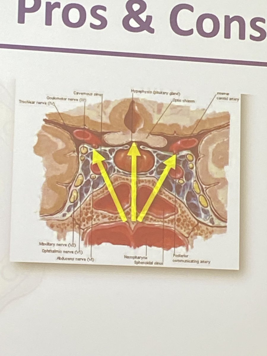 Lindy Drollinger (@lindydrollinger) on Twitter photo Dr. Youssef presenting on Endoscopic Endonasal Approach to Craniopharyngiomas at the 2025 Carle Illinois Microsurgery and Endoscopic Hands-On Course!
โAI in Skull Base Surgery = Anatomical Intelligence.โ
@waelhassaneen <a href="/ASamyYoussef/">A. Samy Youssef</a> <a href="/CarleHealth/">Carle Health</a> Dr. Youssef presenting on Endoscopic Endonasal Approach to Craniopharyngiomas at the 2025 Carle Illinois Microsurgery and Endoscopic Hands-On Course!
โAI in Skull Base Surgery = Anatomical Intelligence.โ
@waelhassaneen <a href="/ASamyYoussef/">A. Samy Youssef</a> <a href="/CarleHealth/">Carle Health</a>