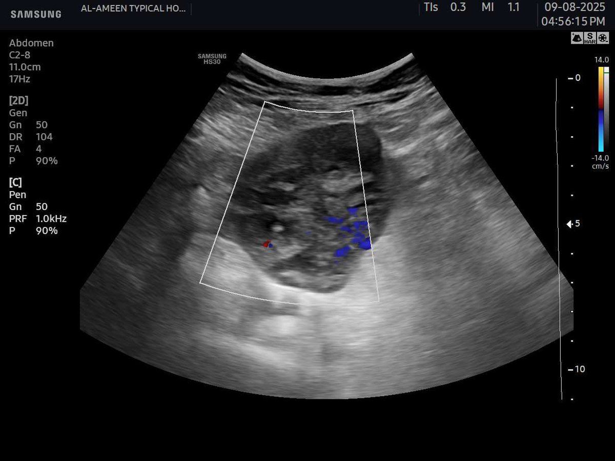 EchoTech_4's tweet image. Challenge: try to give a good DDX and recommendation without clinical and lab 
These images for sigmoid colon .

Your opinion?

#EchoTech