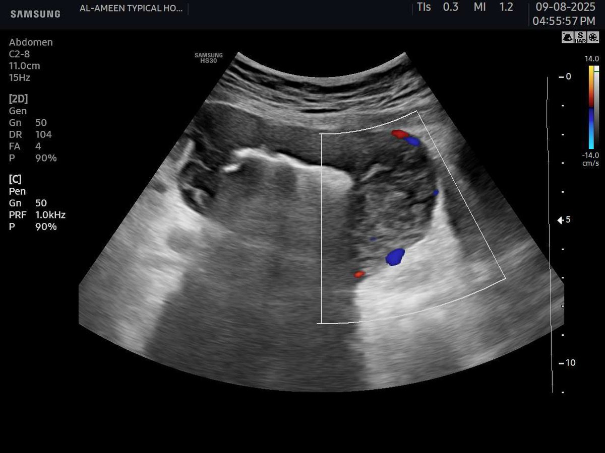 EchoTech_4's tweet image. Challenge: try to give a good DDX and recommendation without clinical and lab 
These images for sigmoid colon .

Your opinion?

#EchoTech