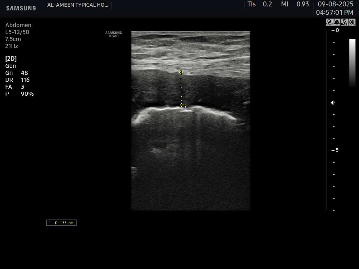EchoTech_4's tweet image. Challenge: try to give a good DDX and recommendation without clinical and lab 
These images for sigmoid colon .

Your opinion?

#EchoTech