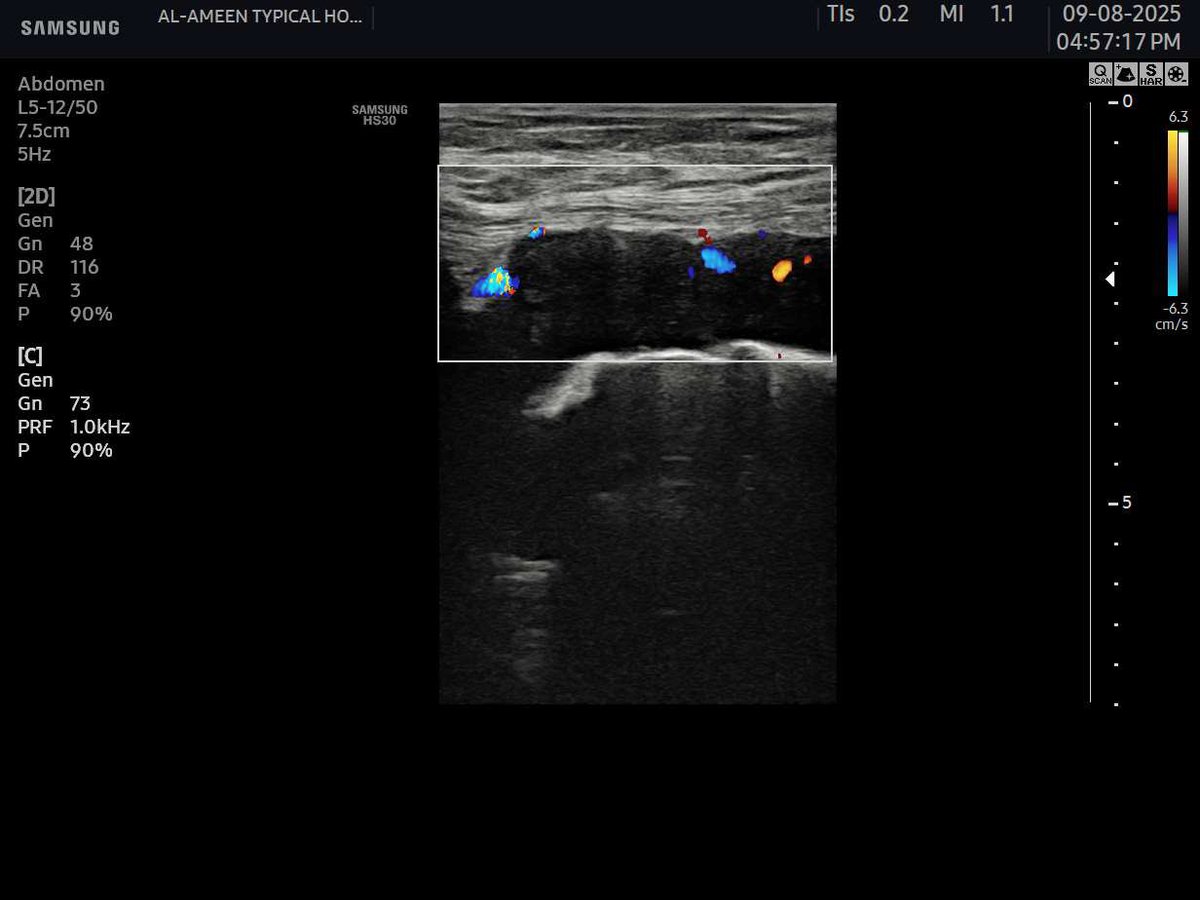 EchoTech_4's tweet image. Challenge: try to give a good DDX and recommendation without clinical and lab 
These images for sigmoid colon .

Your opinion?

#EchoTech