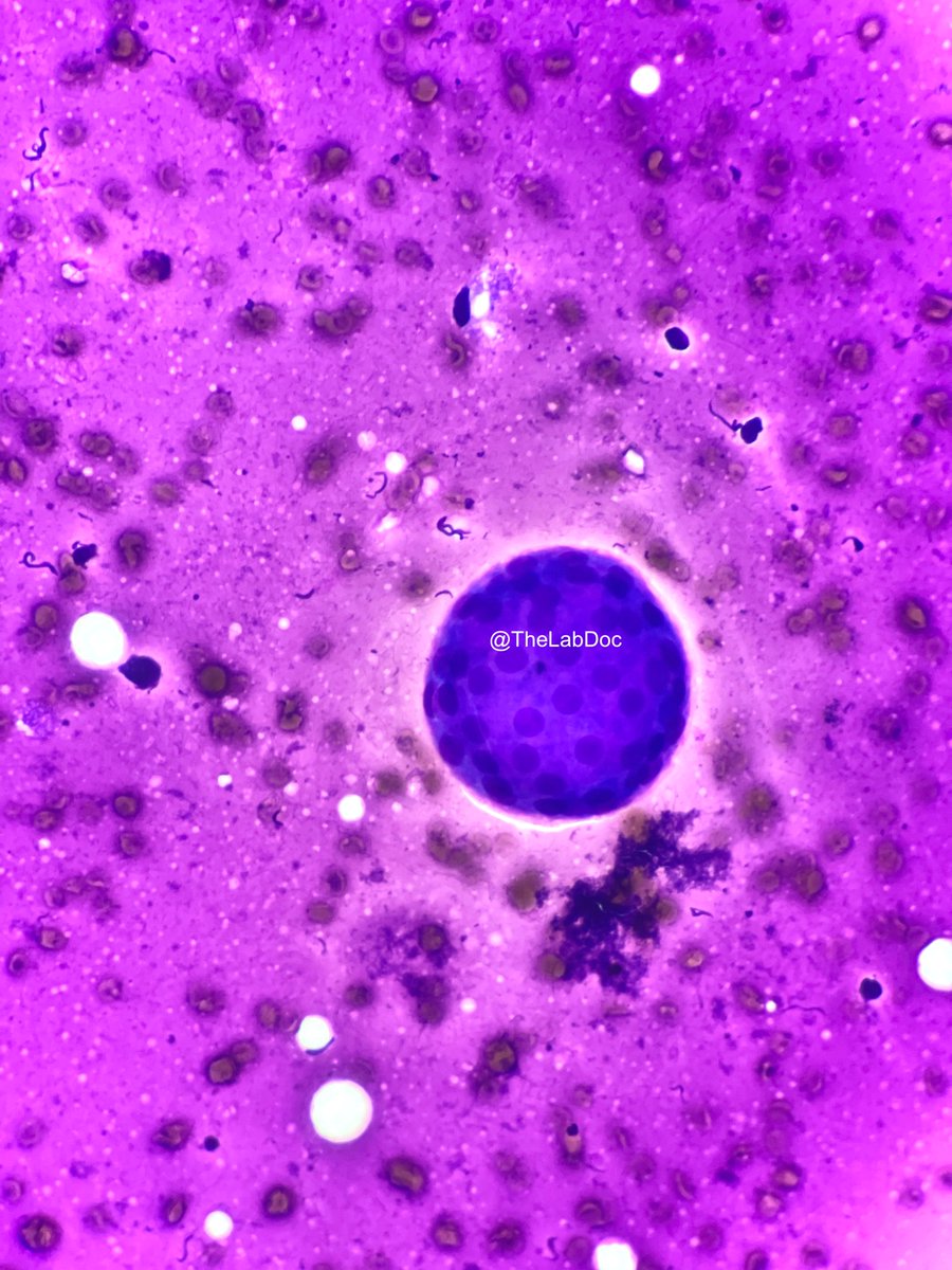 Spherule-thyroid FNA (DQ)
Round cohesive cluster of follicular cells forming 3D sphere ±colloid
Note bland nuclei, smooth contours
Supportive of benign Dx (contextual)

Contrast to microfollicles (&lt;15 cells, scant colloid, tight sphere), suggesting follicular lesion
#PathTwitter