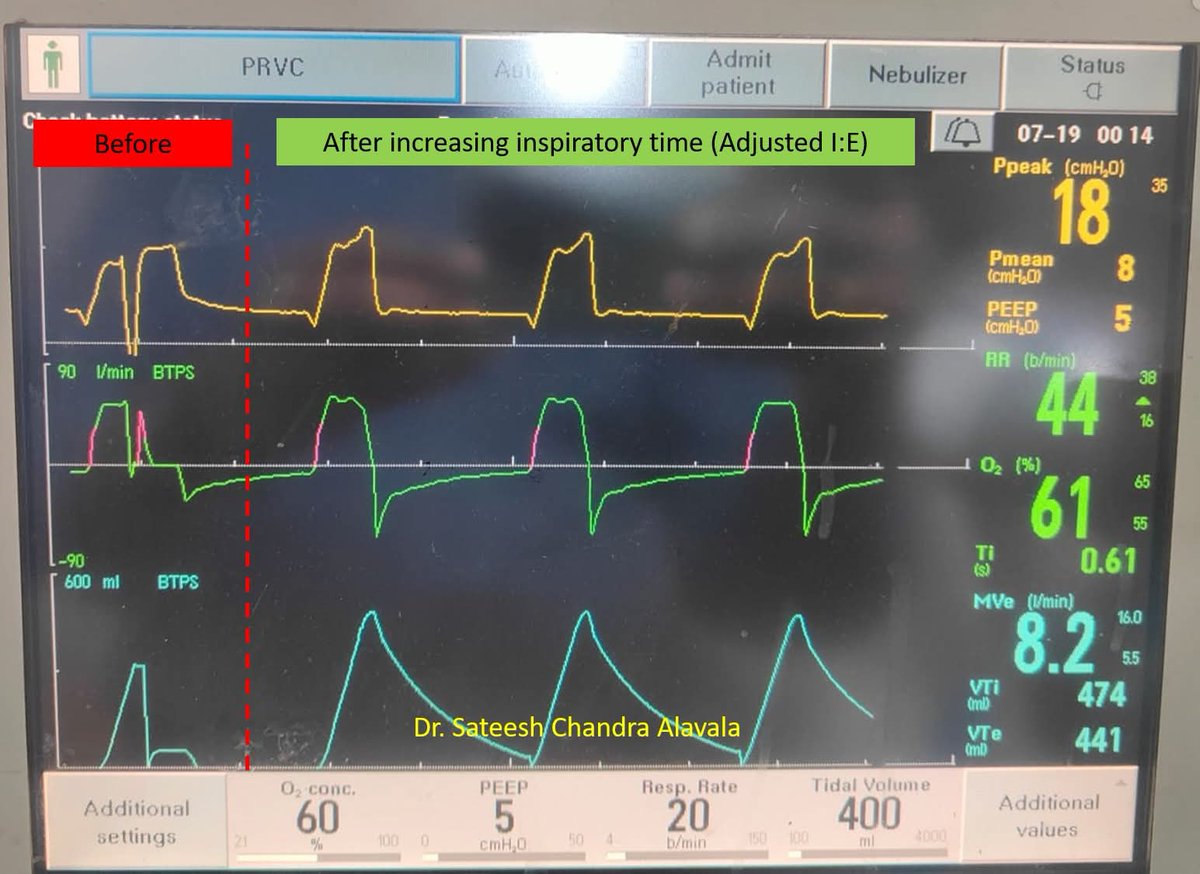 Double trigger due to early cycling