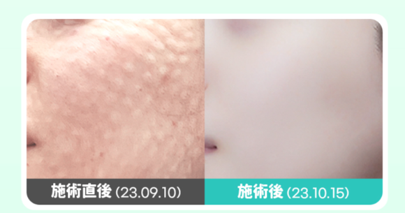 YOURCLINICJP's tweet photo. 垢抜けは美肌から🤍注入だけで ＃水光肌 の完成✨
夏の #肌育 は #ベンスクリニック で完結‼#ホンデ #明洞 #江南 #龍山

#リジュラン 2㏄ 初回9.9万₩
#スキンボトックス 1㏄2.9万₩
#水光注射 1㏄4.9万₩
#ジュベルック 1㏄初回2.9万₩

RT&amp;フォローで7月以降も適用可能✨

#肌管理  #毛穴レス #弾力 https://t.co/jSAsOBiQ2V
