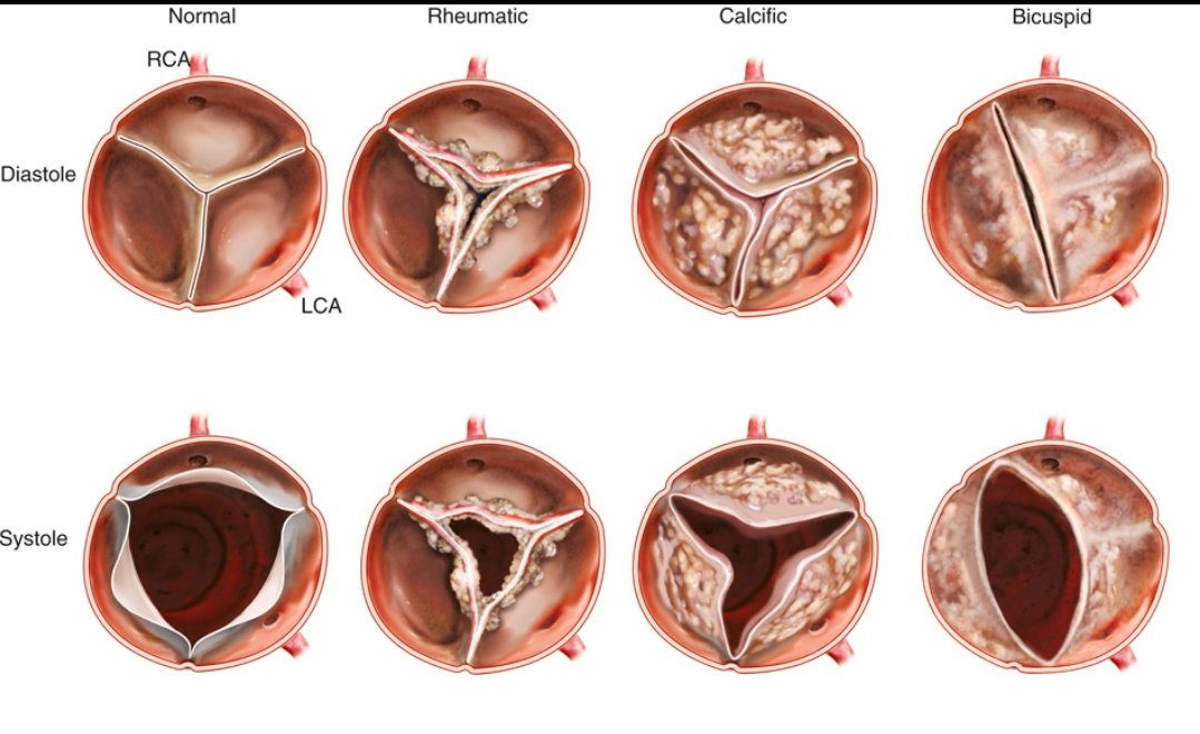 TrackYourHeart's tweet photo. Three main causes of aortic stenosis https://t.co/n4HONuMuAo