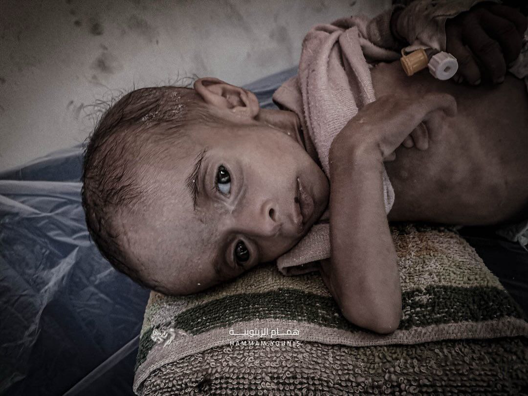 La niña #palestina Judy de 4 meses, sufre de desnutrición debido al continuo asedio y la prohibición de entrada de alimentos y leche para bebés en #Gaza.