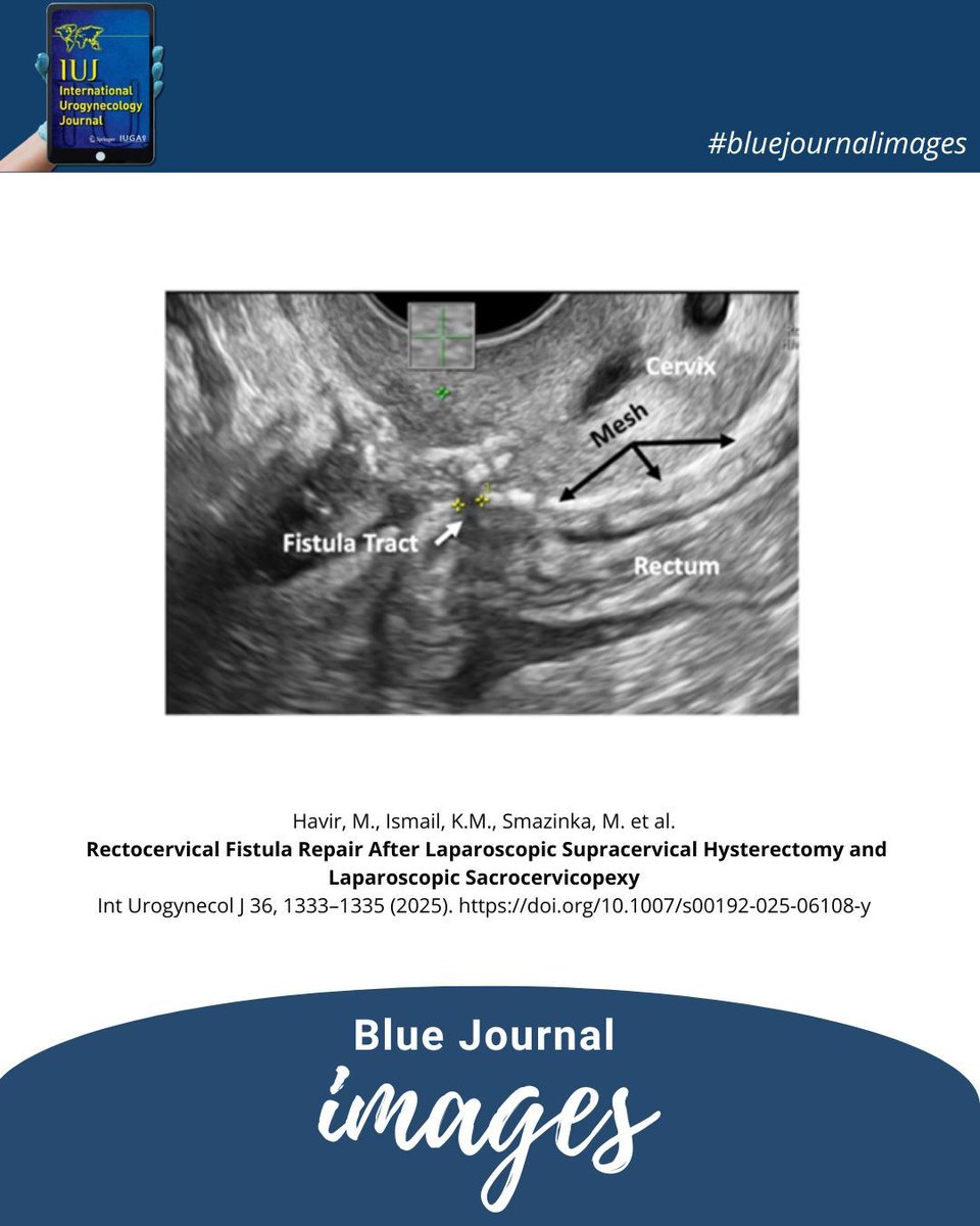 #bluejournalimages: Laparoscopic repair of a rectocervical fistula after a urogynecological surgery - an excellent video article by Havir et al.

📌 link.springer.com/article/10.100… 

<a href="/iugaoffice/">International Urogynecological Association (IUGA)</a> @clinmedjournals

#urogynecology #iuj_bluejournal #surgery #laparoscopy