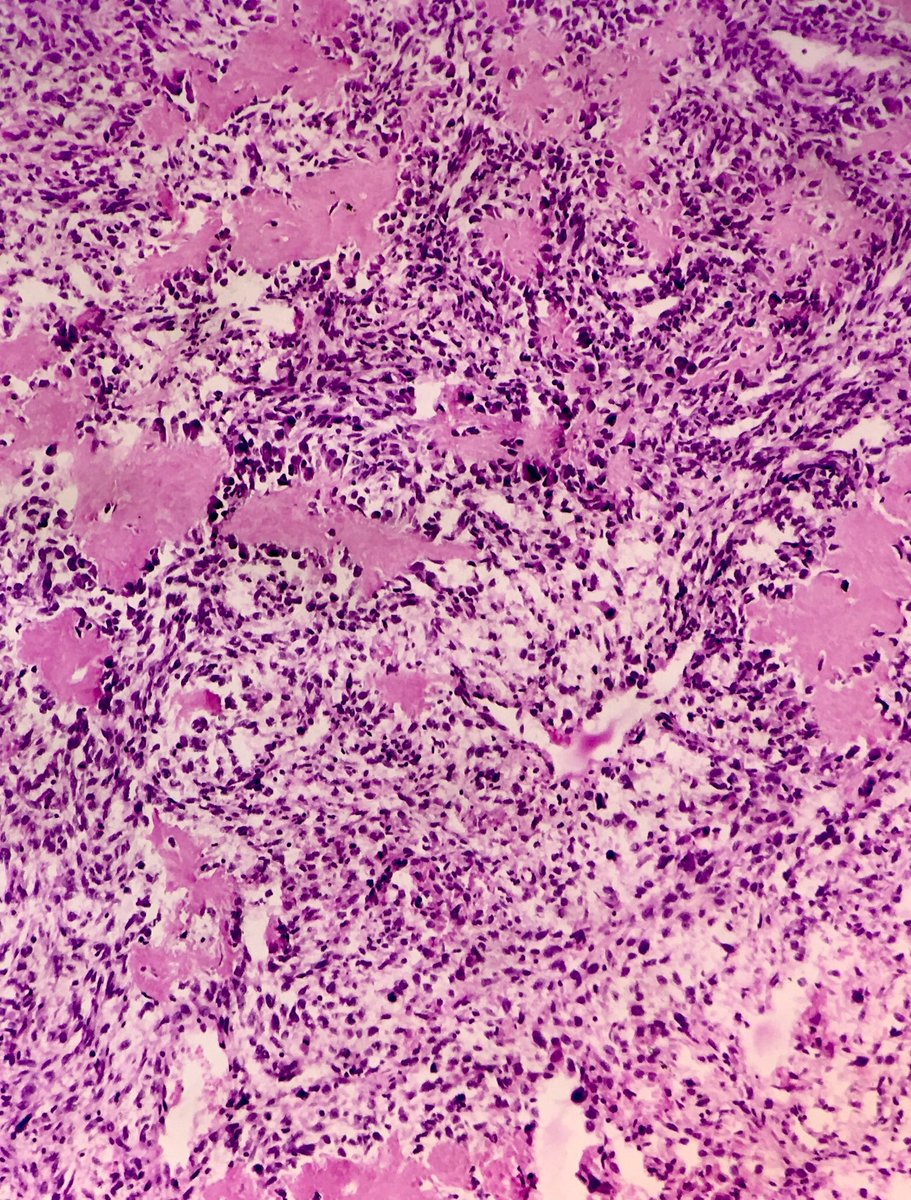 ⚡️ Tibial mass in a middle-aged man
Stone turned soft, soft turned wild — and the scaffold rebelled ..