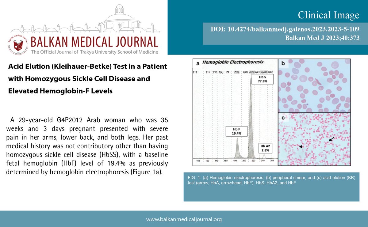 Acid Elution (Kleihauer-Betke) Test in a Patient with Homozygous Sickle Cell Disease and Elevated Hemoglobin-F Levels
You can see the free full text of the research by Furkan Yiğitbilek et al.
Link : balkanmedicaljournal.org/uploads/pdf/pd…