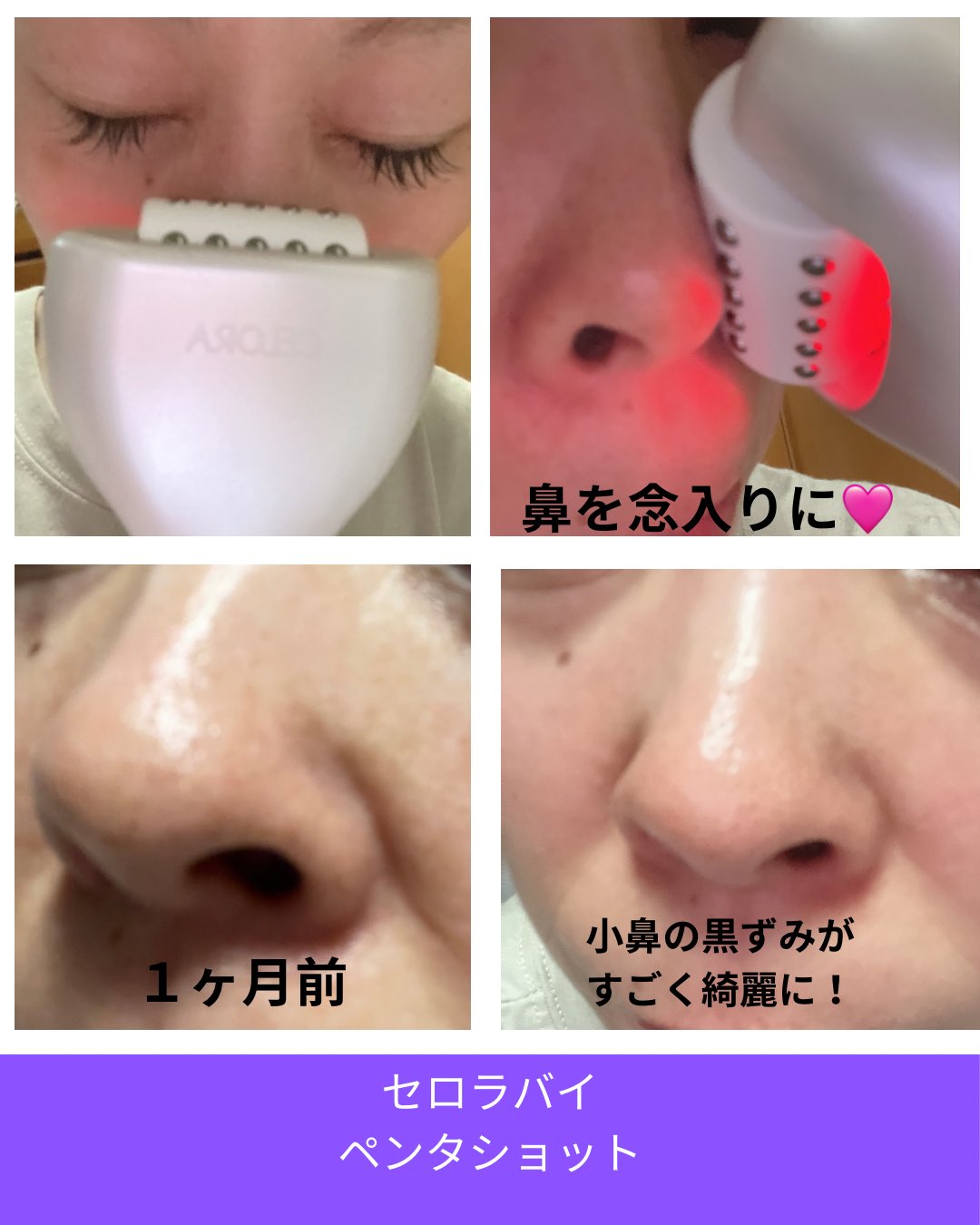 マスクを外した今❣️見られている 目元 肌 口元ケア ❤︎ RF美顔器 自宅エステ 美顔器 - Search / X