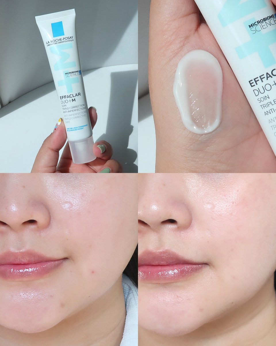 มอยส์ฯของคนเป็นสิว หลอดเดียวที่ใช้แล้วสิวลดจริงเห็นผลจริง ยกให้ La Roche-Posay Effaclar DUO+M หลอดนี้จริงๆ สิวอักเสบยุบไว พวกรอยสิวก็จางลง เนื้อไม่หนัก ใช้แล้วหน้าไม่แห้งเลย อ่อนโยนกับผิวแพ้ง่าย ใครเป็นสิวบ่อย มีสิวกรอบหน้าแบบเราไปลองงงง