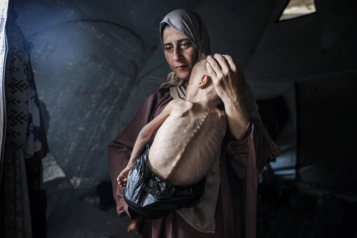 Left is a child with cerebral palsy OUTSIDE Gaza
Right is a child with cerebral palsy INSIDE Gaza

Israel blaming cerebral palsy for kids starving to death in Gaza is an admission of both starving them &amp; denying them medicine!