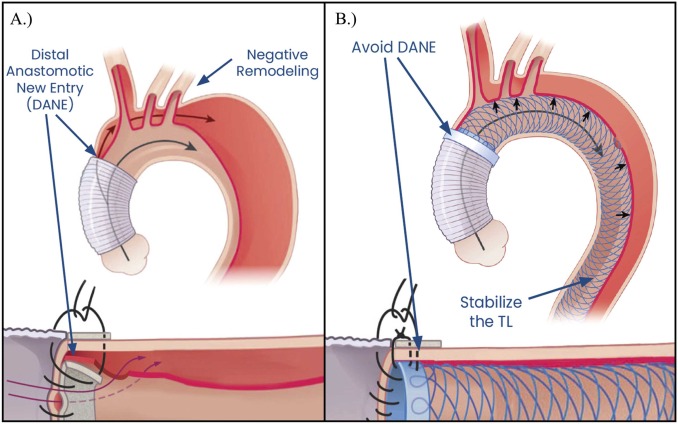 The bare metal AMDS stent yields key benefits in the management of patients with DeBakey I aortic dissections, promoting positive remodeling with a familiar hemiarch operation. What role should it play in dissection management? We discuss in our review:
authors.elsevier.com/a/1lWBZ3jAej9N…