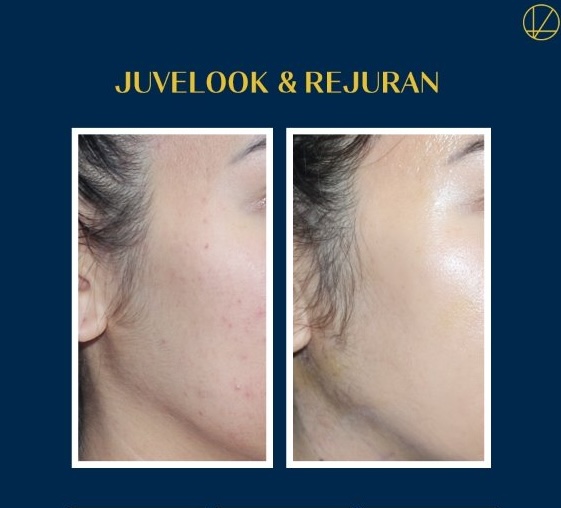 話題のスキンブースター❣️肌管理＆肌再生・弾力UP✨
【リジュベルック 💉💖(リジュラン × ジュベルック)】

✔ コラーゲン生成で自然なハリ✨
✔ たるみ＆ダメージ肌を修復💎
✔毛穴・赤み・ニキビ跡に

👨🏻‍⚕️キードクター公式認定
💌ご予約LINE
lin.ee/8aSeu34