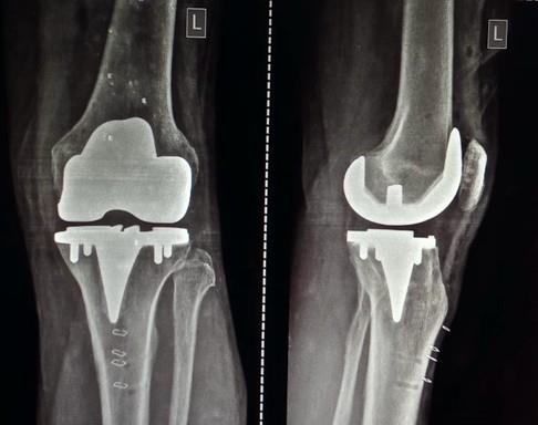 Real-Time Innovations (RTI) (@rti_software) on Twitter photo Congrats to <a href="/monogramortho/">Monogram Technologies</a> on completing the world’s first fully autonomous saw-based robotic knee replacement! This milestone proves the mBôs TKA System can execute precise surgical plans with minimal human input — a leap beyond today’s semi-autonomous systems. Congrats to <a href="/monogramortho/">Monogram Technologies</a> on completing the world’s first fully autonomous saw-based robotic knee replacement! This milestone proves the mBôs TKA System can execute precise surgical plans with minimal human input — a leap beyond today’s semi-autonomous systems.