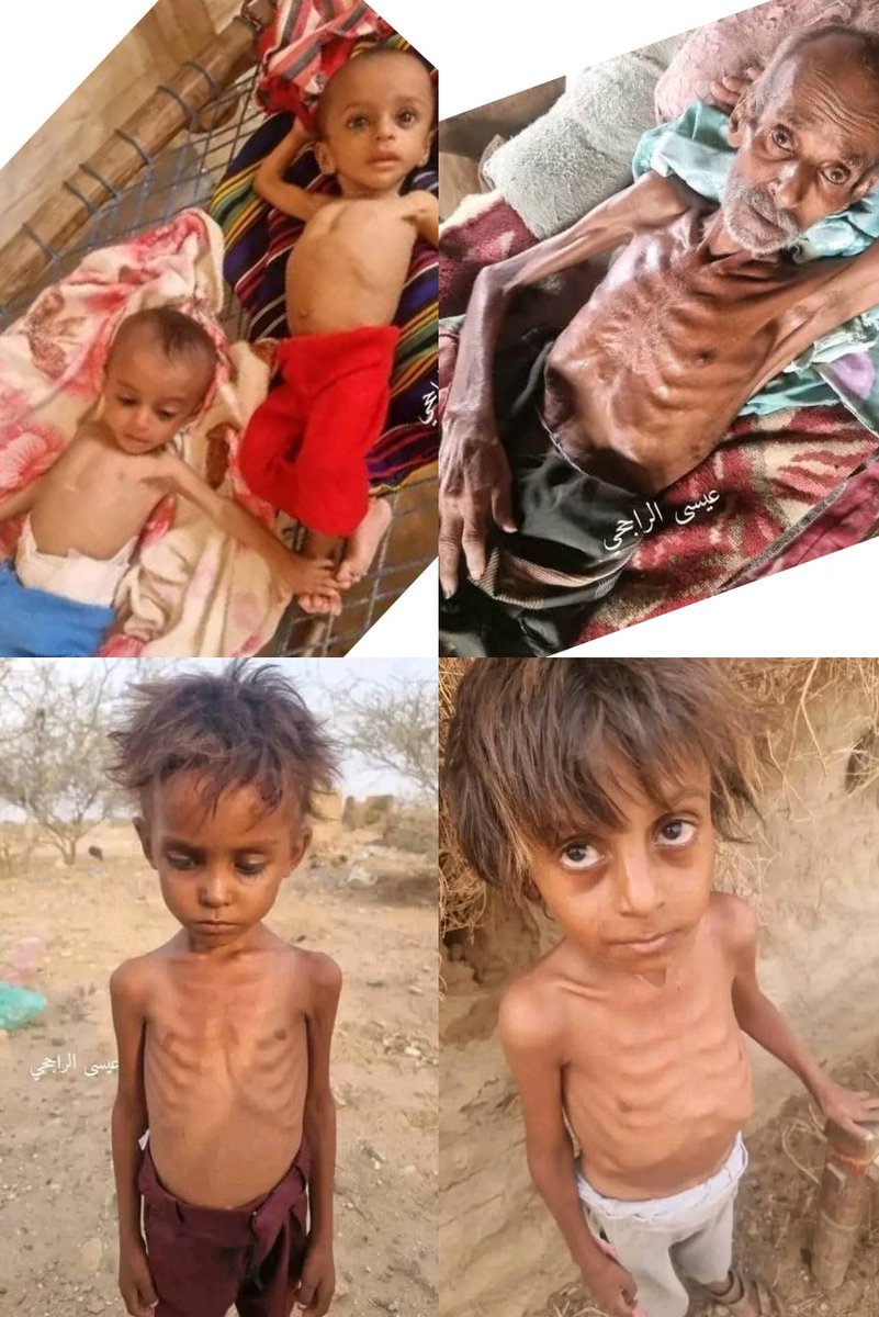 🔴🔴🔴
المجاعة تفتك بالشعب اليمني في ضل حكم مليشيات إيران الإرهابية