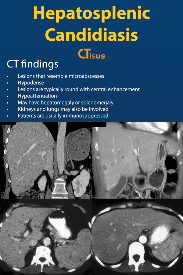 ctisus's tweet photo. Hepatosplenic Candidiasis: CT Findings

https://t.co/fES658EAmn https://t.co/iBC00LEAdg