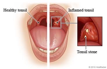 Tonsil Stones vs Bad Breath
What’s Causing That Bad Smell? 🤷🏽‍♂️

Bad breath can be embarrassing and frustrating, especially when you brush and floss regularly but the smell won't go away. 

One hidden cause many people don’t know about?

Let me explain👇🏽
