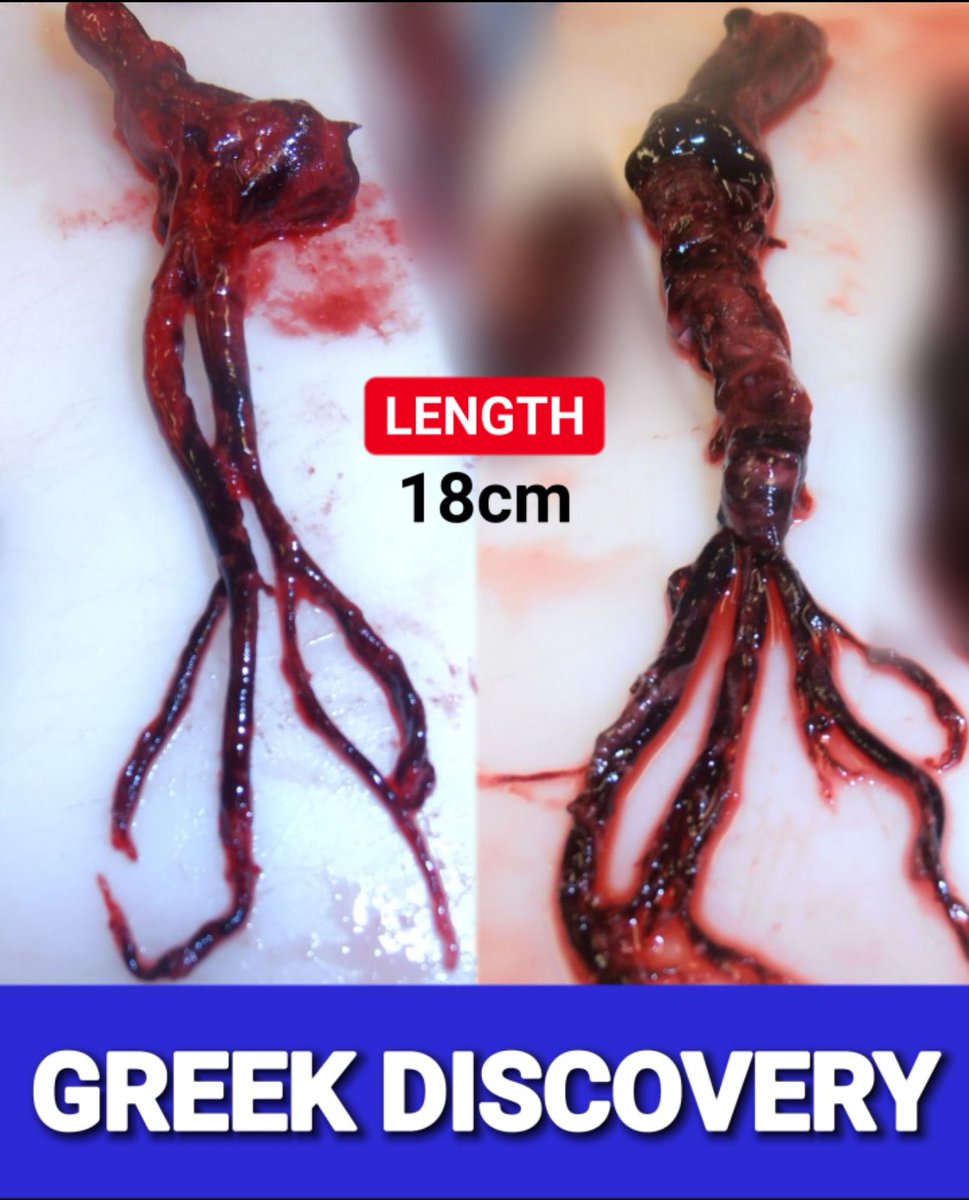 Stefanos Damianidis (@dstefanos) on Twitter photo What do you think these are?
1. Greek calamari
2. The demogorgon (Stranger Things)
3. mRNA generated fibrous blood clots
4. Perfectly normal blood clots
5. I don’t know
#vaccine #mrna #covid19 #Greece #vaccinesafety #embomers #greek #fauci <a href="/RobertKennedyJr/">Robert F. Kennedy Jr</a> <a href="/SecKennedy/">Secretary Kennedy</a> What do you think these are?
1. Greek calamari
2. The demogorgon (Stranger Things)
3. mRNA generated fibrous blood clots
4. Perfectly normal blood clots
5. I don’t know
#vaccine #mrna #covid19 #Greece #vaccinesafety #embomers #greek #fauci <a href="/RobertKennedyJr/">Robert F. Kennedy Jr</a> <a href="/SecKennedy/">Secretary Kennedy</a>