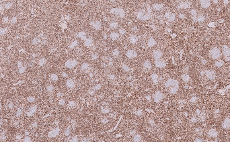 36 yo female, inguinal lymph node. Look at the beautiful BCL2 negative microfillcles: H&amp;E, CD20, CD3 and BCL2. What immunostain besides CD10 and BCL6 would you expect to be positive? Answer inside 😉