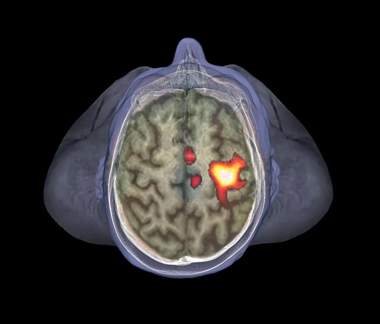 Nature 

The brain fires up immune cells when sick people are nearby

When people viewed virtual avatars with coughs or rashes, their brains triggered an immune response.

nature.com/articles/d4158…